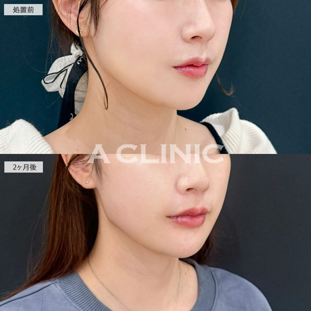 1day小顔脂肪吸引でアゴ下のお肉が減ってスッキリとした輪郭になりました！処置前と2ヶ月後の症例です(30代女性)