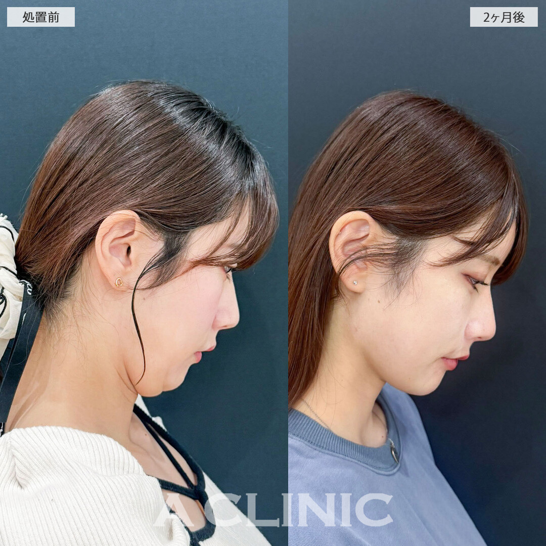 1day小顔脂肪吸引でアゴ下のお肉が減ってスッキリとした輪郭になりました！処置前と2ヶ月後の症例です(30代女性)
