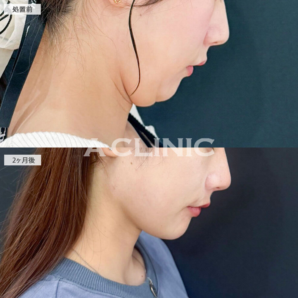 1day小顔脂肪吸引でアゴ下のお肉が減ってスッキリとした輪郭になりました！処置前と2ヶ月後の症例です(30代女性)