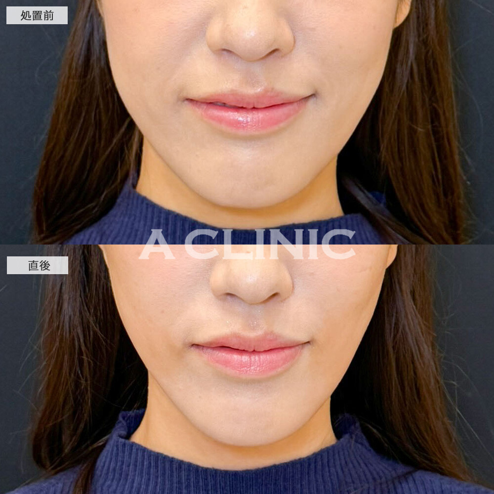 Aスレッドでたるみを一気に引き上げ左右差の悩みが解消しました！こちら処置前と直後の症例です(30代女性)