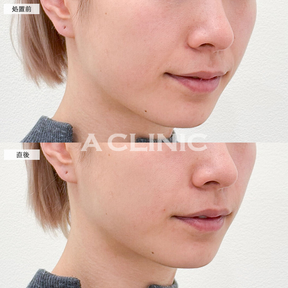 ほうれい線へのヒアルロン酸注入で自然に若返り！こちら処置前と直後の症例です(20代女性)