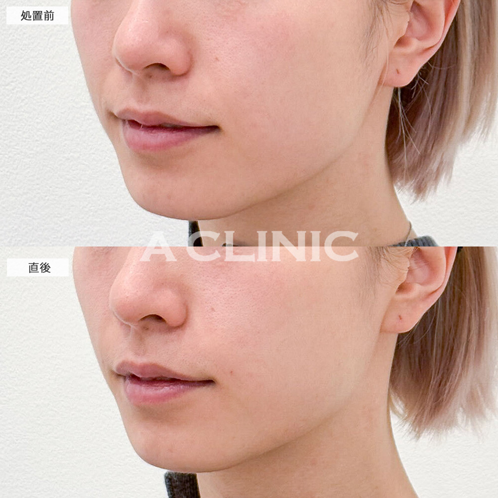 ほうれい線へのヒアルロン酸注入で自然に若返り！こちら処置前と直後の症例です(20代女性)