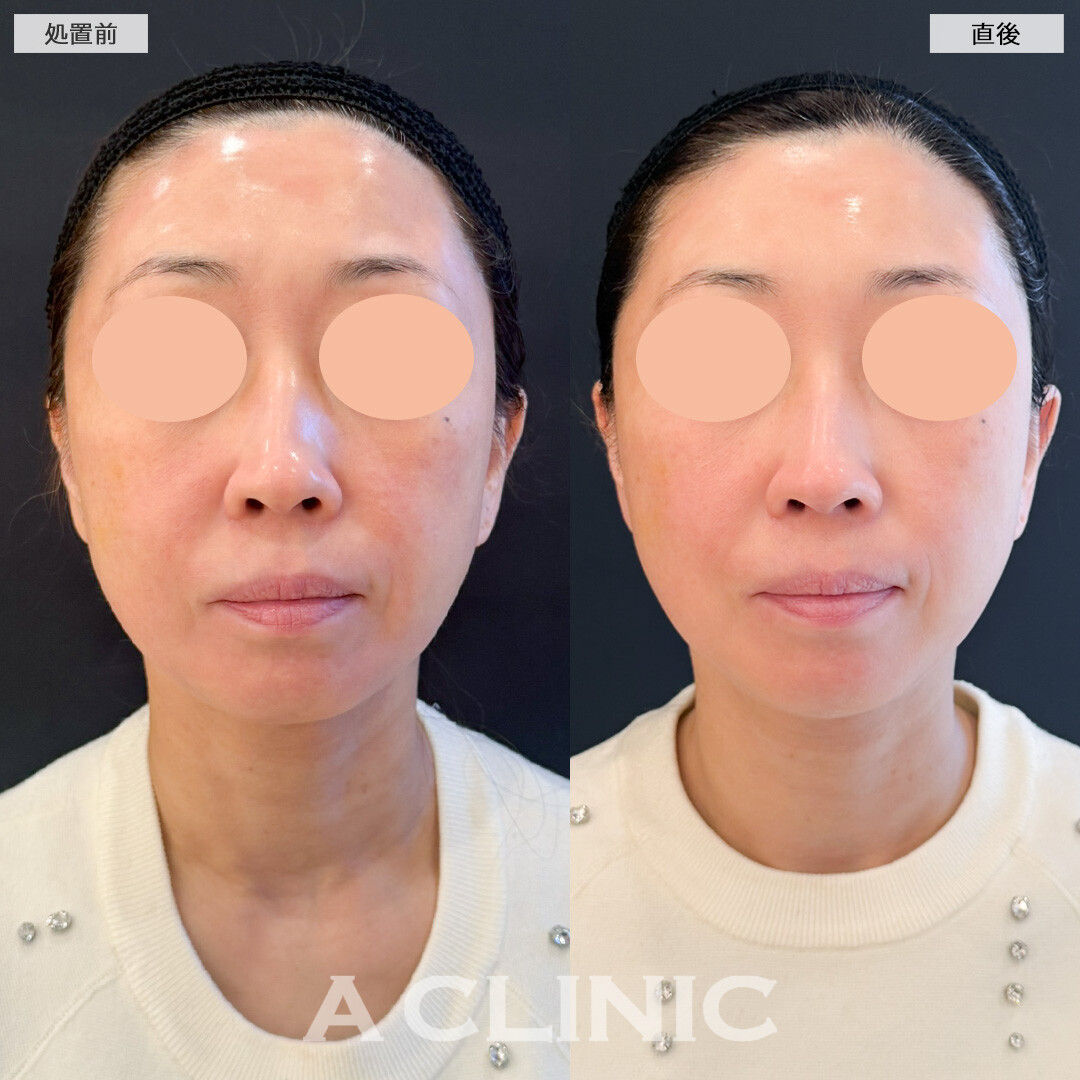 XERF(ザーフ)でお顔全体がキュッと持ち上がった印象になりました！処置前と直後の症例です(40代女性)