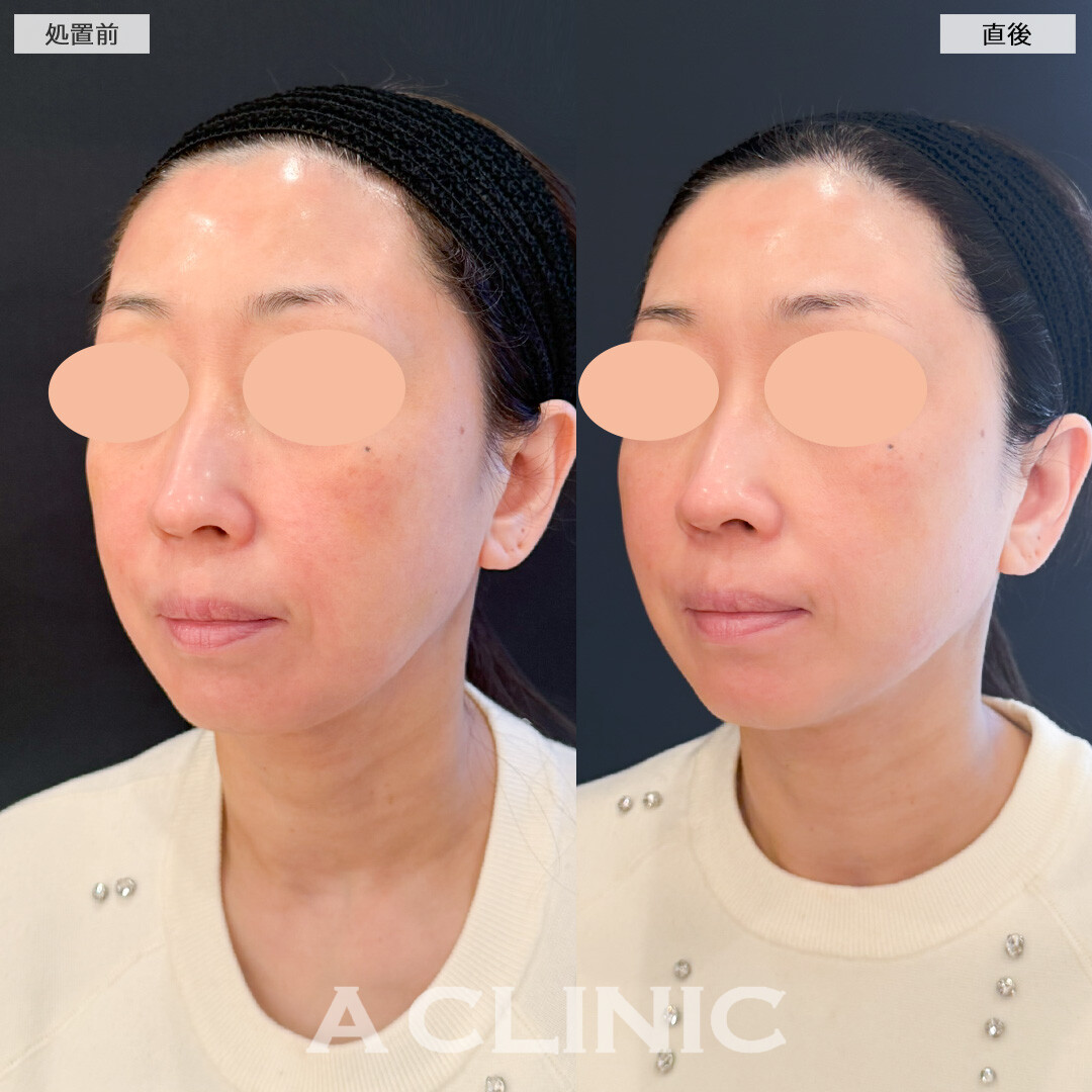 XERF(ザーフ)でお顔全体がキュッと持ち上がった印象になりました！処置前と直後の症例です(40代女性)