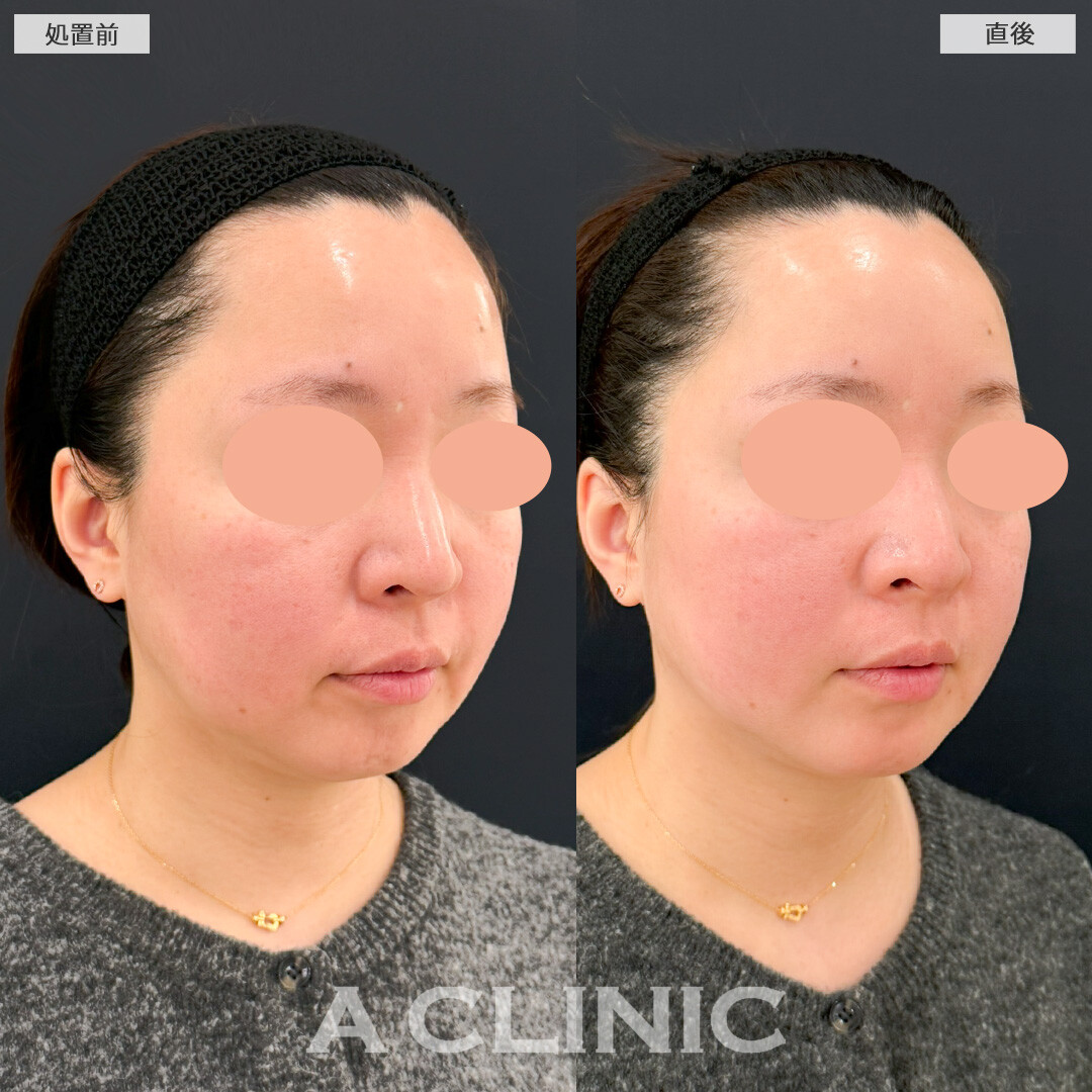 XERF(ザーフ)で口横と輪郭のたるみ予防改善が同時に叶う！処置前と直後の症例です(40代女性)