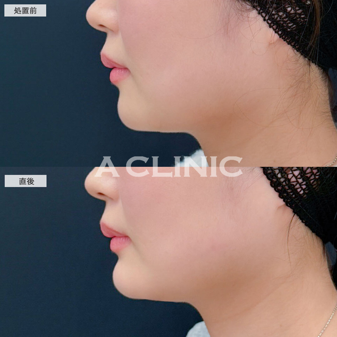 あごへのヒアルロン酸注入で横顔に立体感がでました！こちら処置前と直後の症例です(20代女性)