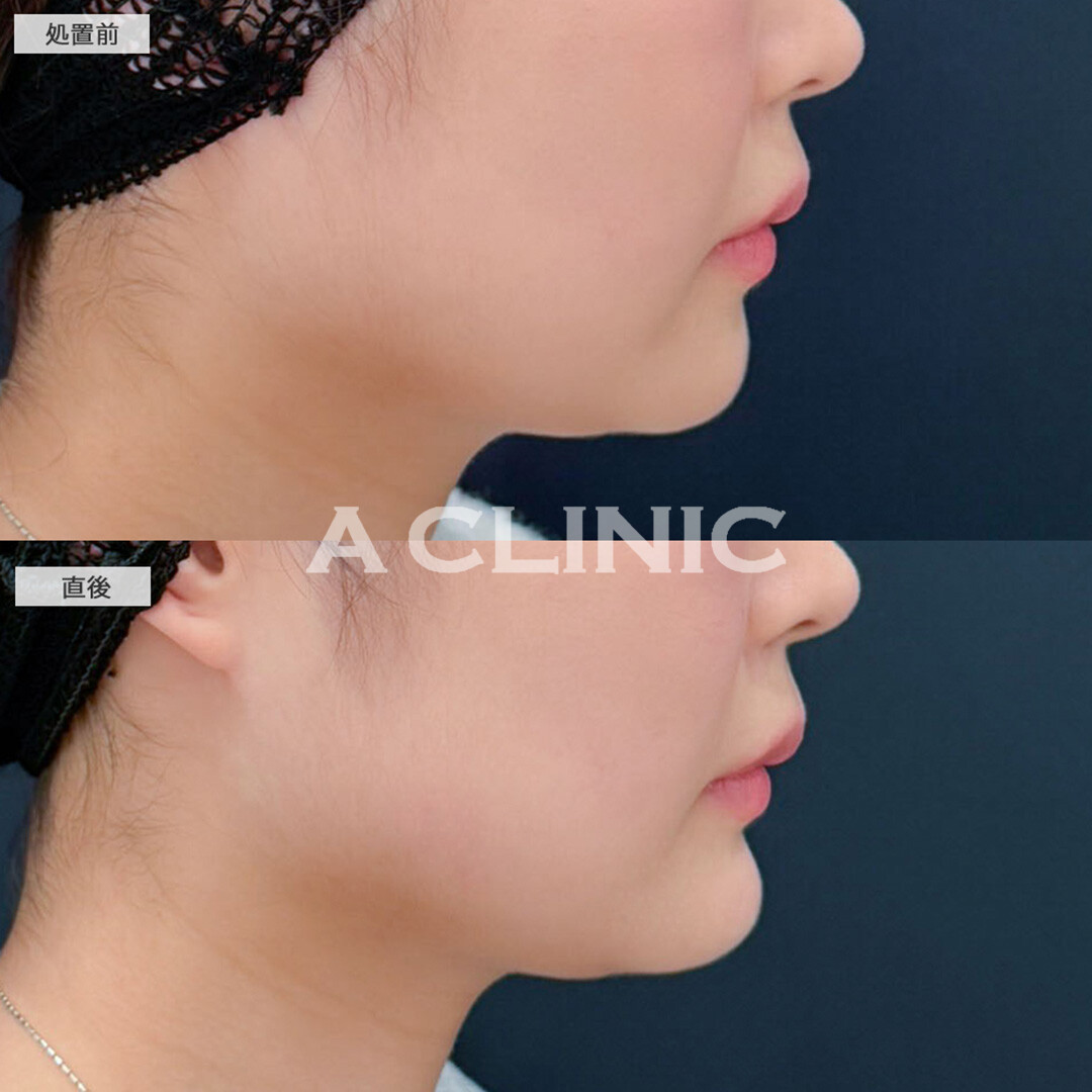 あごへのヒアルロン酸注入で横顔に立体感がでました！こちら処置前と直後の症例です(20代女性)
