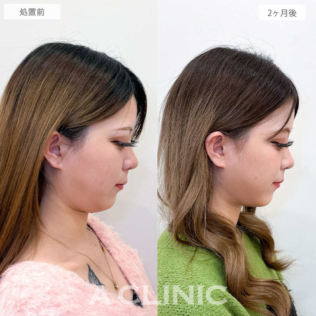 1day小顔脂肪吸引と小顔エラボトックスで首との境目がクッキリシャープになりました！処置前と2ヶ月後の症例です(20代女性)