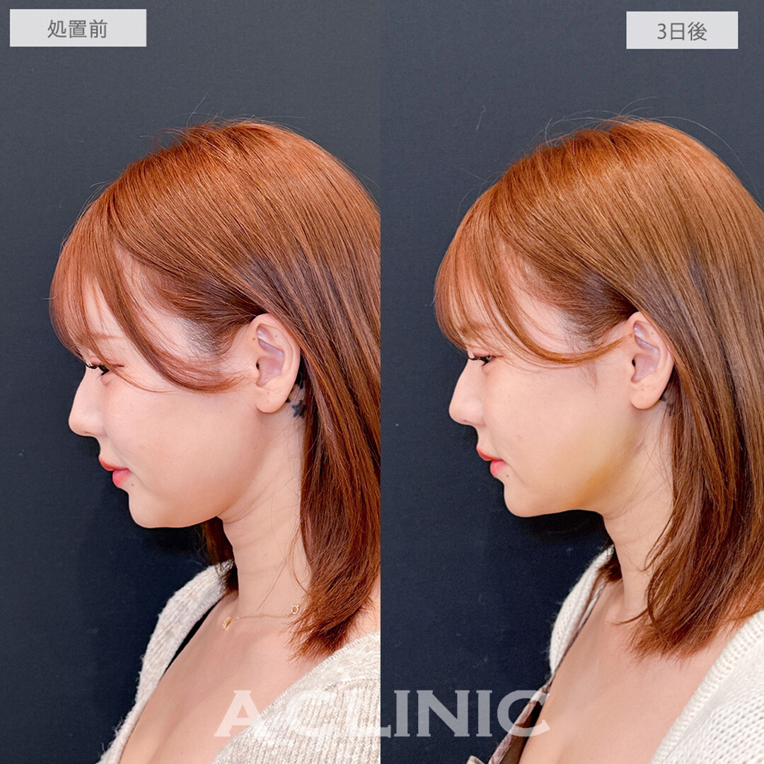 1day小顔脂肪吸引でコンプレックスだった二重あごがスッキリ消えた！処置前と1ヶ月後の症例です(30代女性)