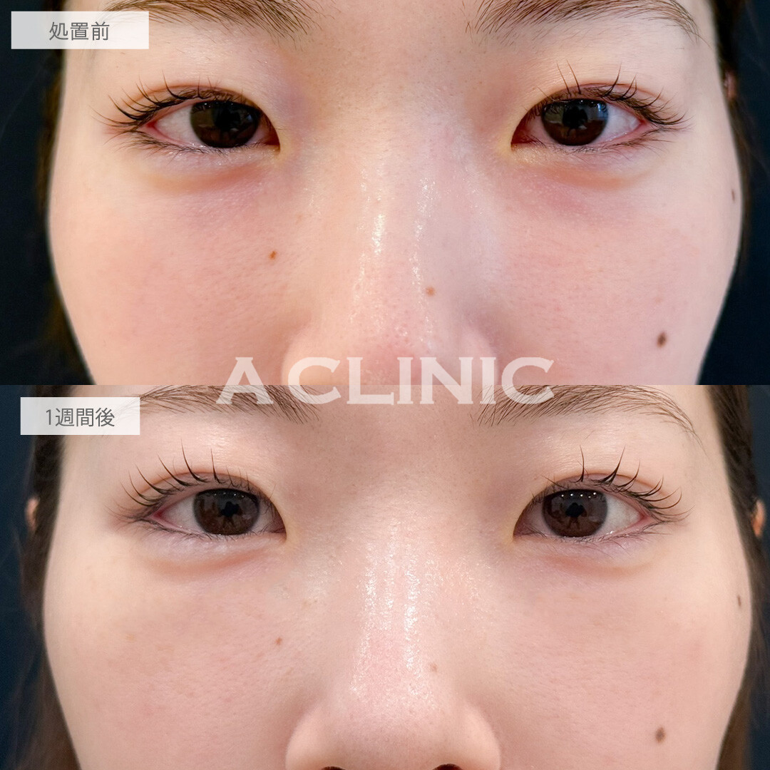 A式コンシーラー注射でクマをコンシーラーで隠す必要がなくなりました！こちら処置前と1週間後の症例です(20代女性)