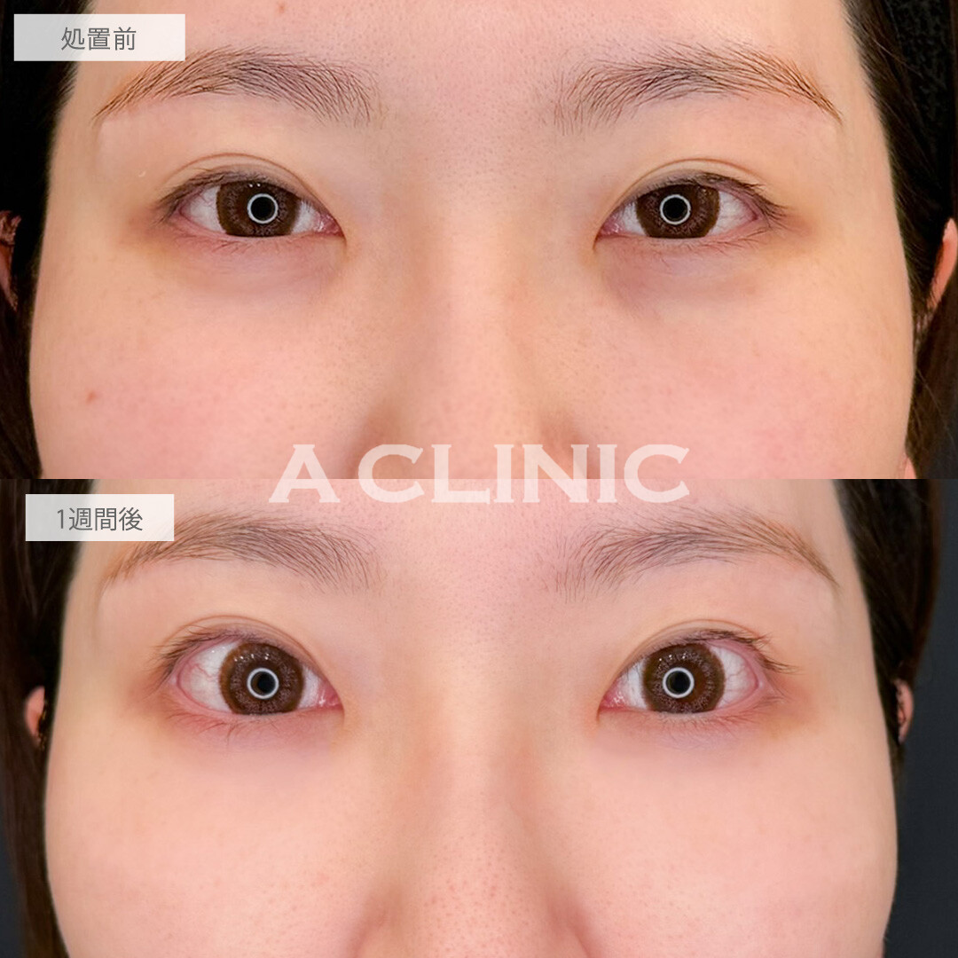 A式コンシーラー注射で目元の印象を明るくチェンジ！こちら処置前と1週間後の症例です(30代女性)