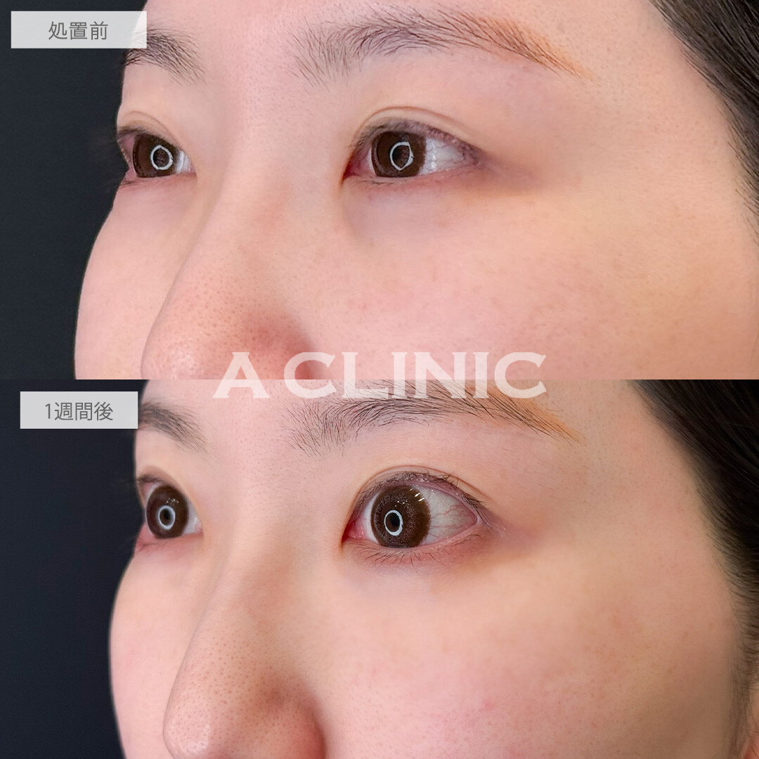 A式コンシーラー注射で目元の印象を明るくチェンジ！こちら処置前と1週間後の症例です(30代女性)