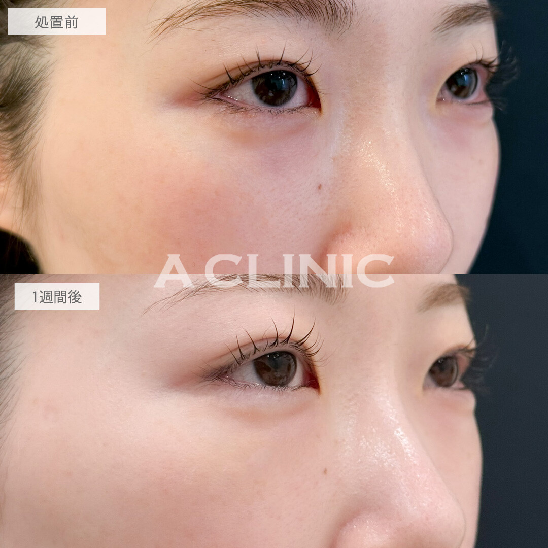 A式コンシーラー注射でクマをコンシーラーで隠す必要がなくなりました！こちら処置前と1週間後の症例です(20代女性)