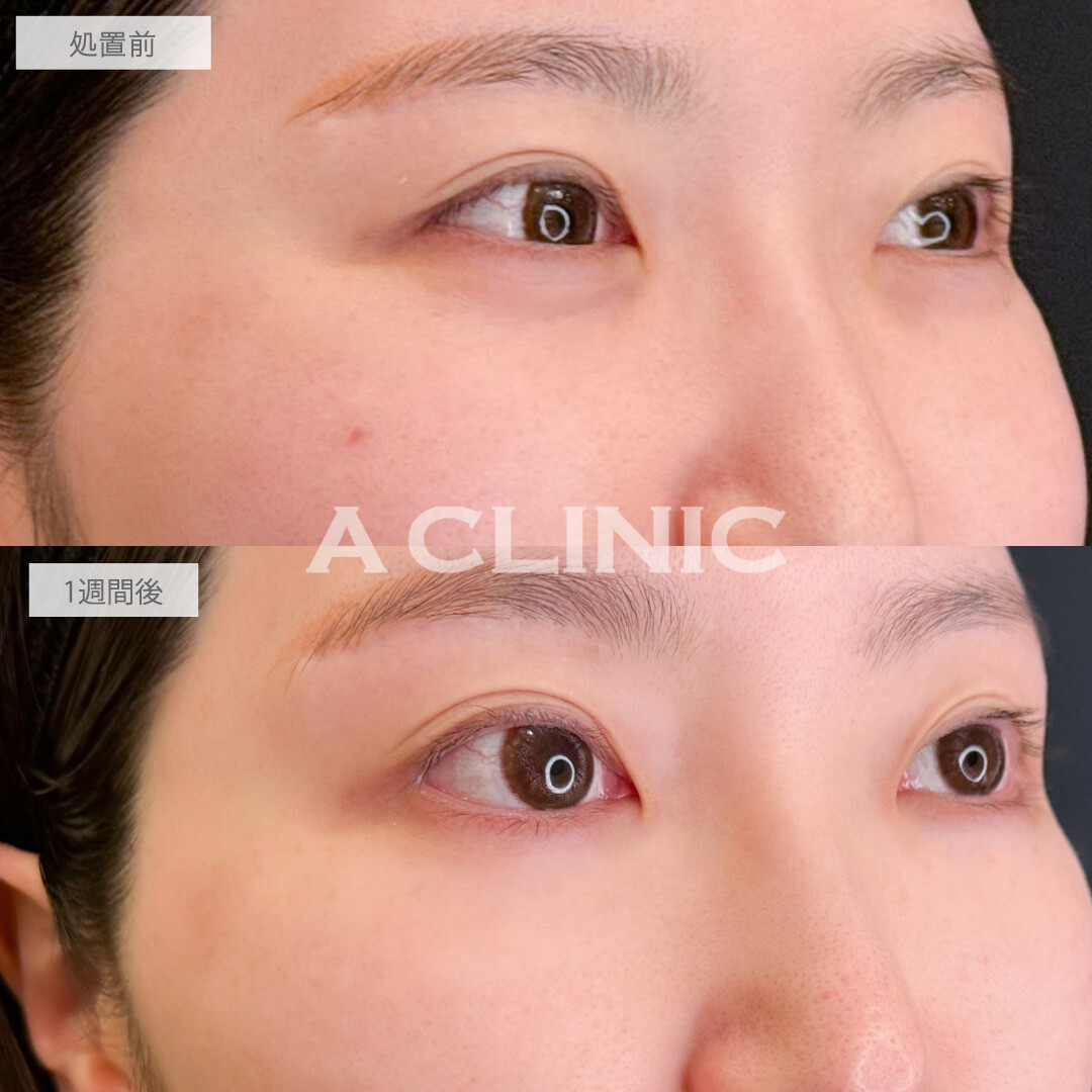 A式コンシーラー注射で目元の印象を明るくチェンジ！こちら処置前と1週間後の症例です(30代女性)