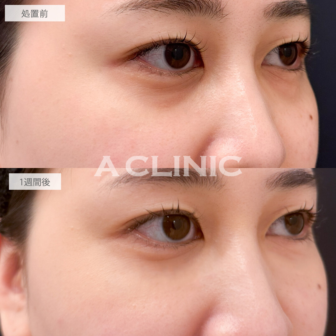 A式コンシーラー注射は注入だけでクマが目立たなくなります！こちら処置前と1週間後の症例です(30代女性)