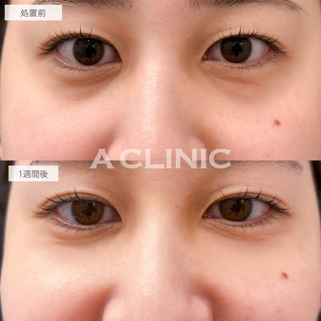 A式コンシーラー注射は注入だけでクマが目立たなくなります！こちら処置前と1週間後の症例です(30代女性)