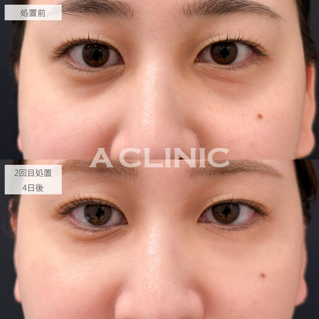 A式コンシーラー注射で目元のお悩みを土台から整えられます！こちら処置前と2回目処置4日後の症例です(30代女性)