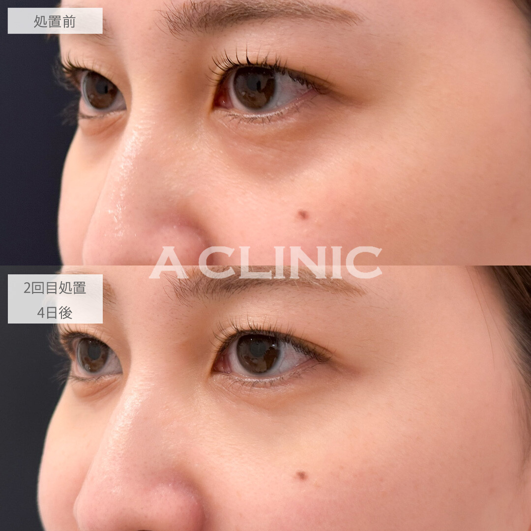 A式コンシーラー注射で目元のお悩みを土台から整えられます！こちら処置前と2回目処置4日後の症例です(30代女性)