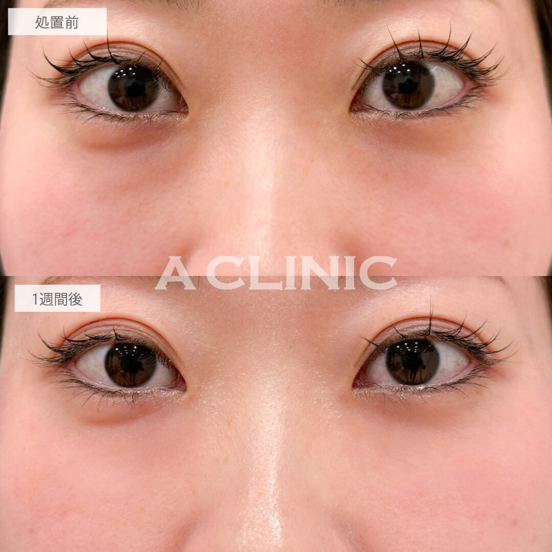 A式コンシーラー注射でコンシーラーに頼らなくても自然で明るい目元に！こちら処置前と1週間後の症例です(20代女性)