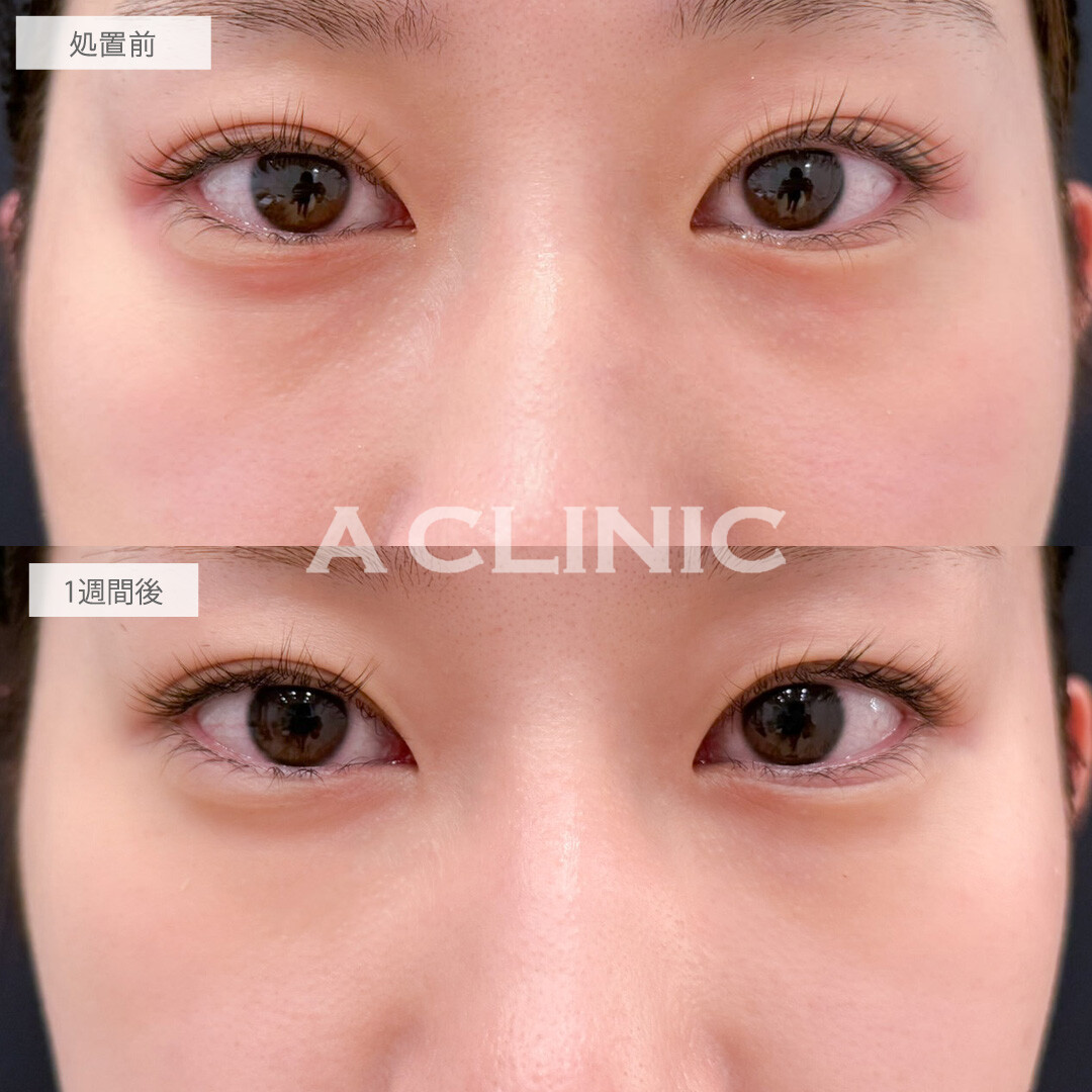 A式コンシーラー注射で目元の凹みと色味を同時に改善できました！こちら処置前と1週間後の症例です(20代女性)