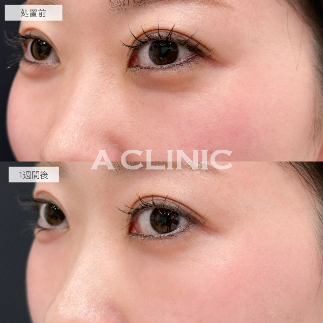 A式コンシーラー注射でコンシーラーに頼らなくても自然で明るい目元に！こちら処置前と1週間後の症例です(20代女性)