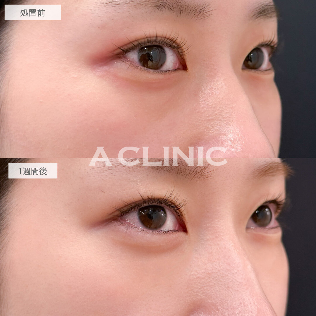 A式コンシーラー注射で目元の凹みと色味を同時に改善できました！こちら処置前と1週間後の症例です(20代女性)