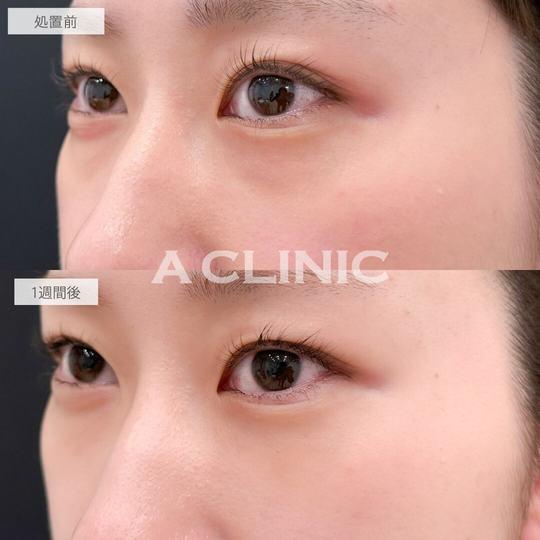 A式コンシーラー注射で目元の凹みと色味を同時に改善できました！こちら処置前と1週間後の症例です(20代女性)