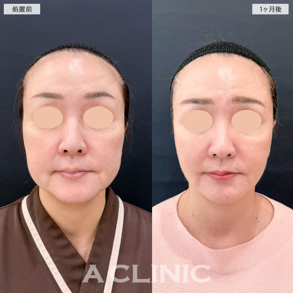 1day小顔脂肪吸引とA式美肌たるみ切開で小顔になっただけでなく輪郭まで滑らかに整いました！こちら処置前と1ヶ月後の症例です(50代女性)