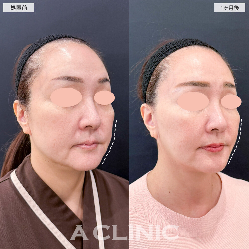 1day小顔脂肪吸引とA式美肌たるみ切開で小顔になっただけでなく輪郭まで滑らかに整いました！こちら処置前と1ヶ月後の症例です(50代女性)