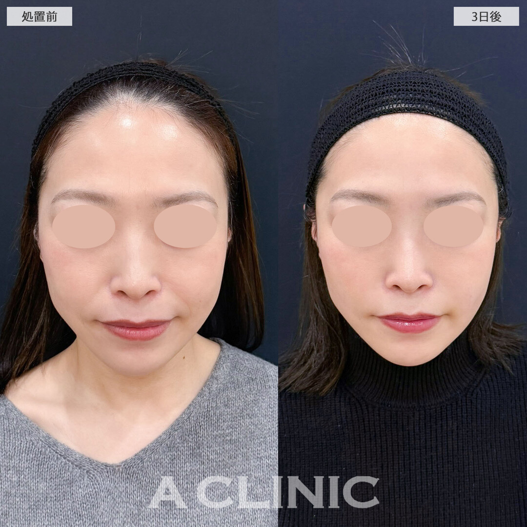 AスレッドでもたつきがなくなりきれいなVフェイスに！こちら処置前と3日後の症例です(30代女性)