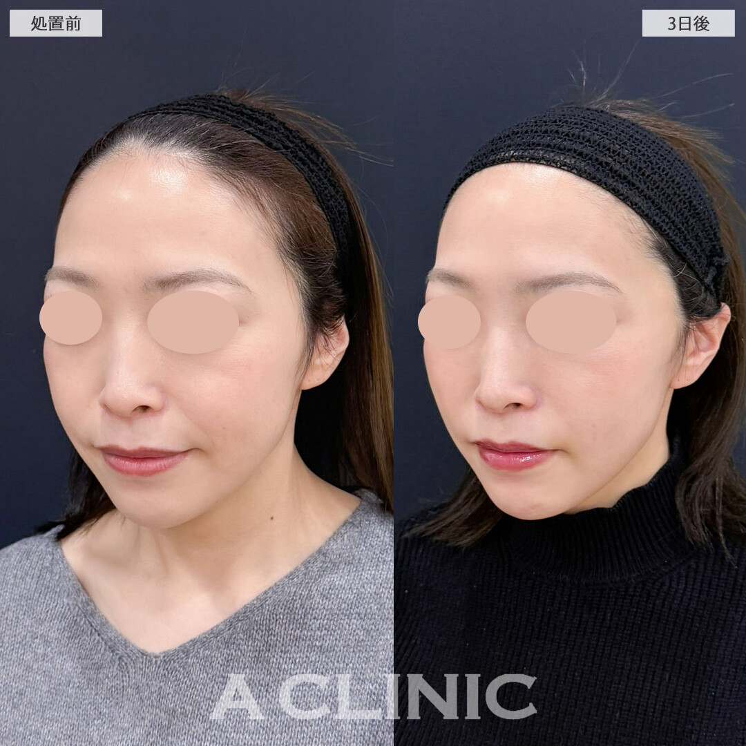 AスレッドでもたつきがなくなりきれいなVフェイスに！こちら処置前と3日後の症例です(30代女性)