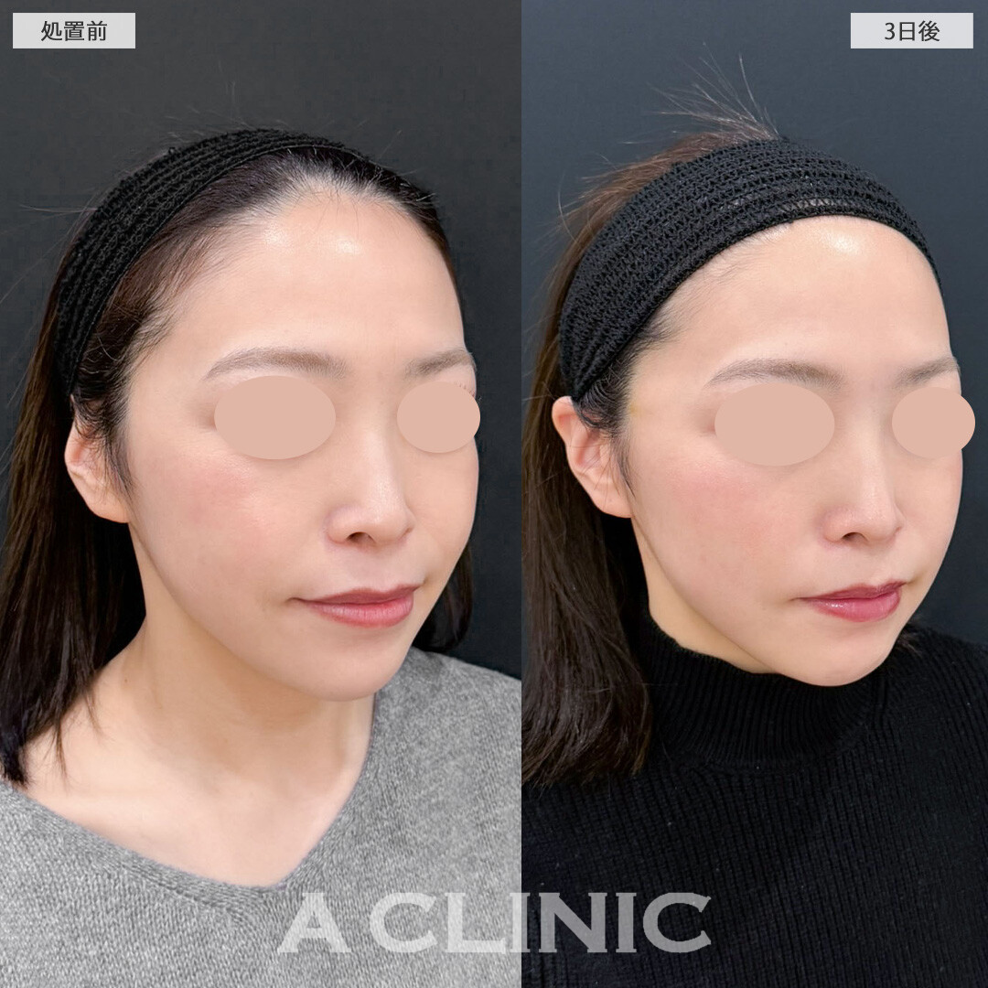 AスレッドでもたつきがなくなりきれいなVフェイスに！こちら処置前と3日後の症例です(30代女性)
