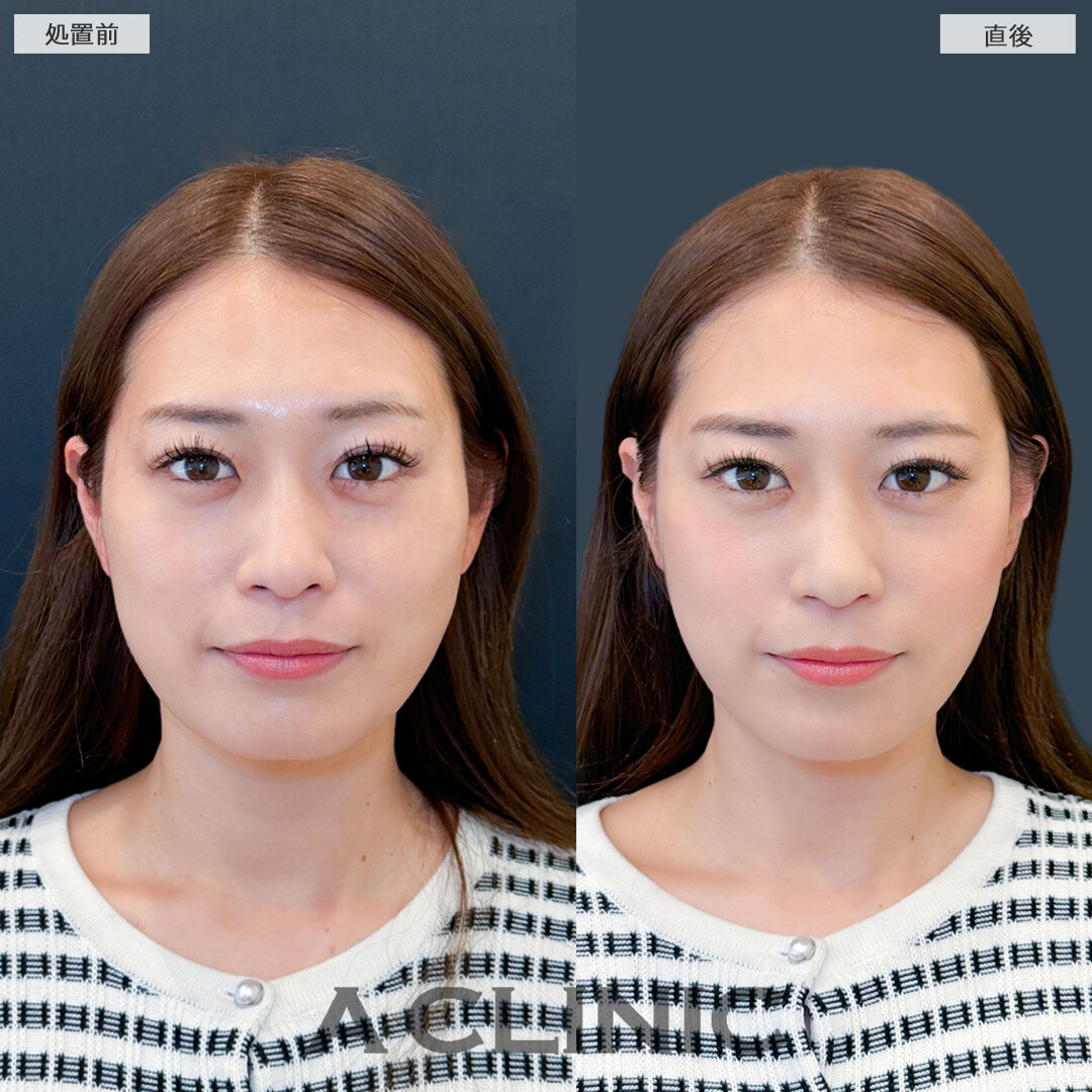Aスレッドでナチュラルにフェイスラインのもたつきを解消！こちら処置前と直後の症例です(30代女性)