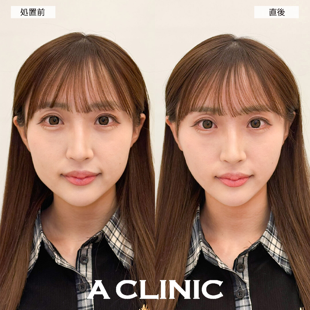 Aスレッドで左右差が改善し中顔面短縮！処置前と直後の症例です(20代女性)