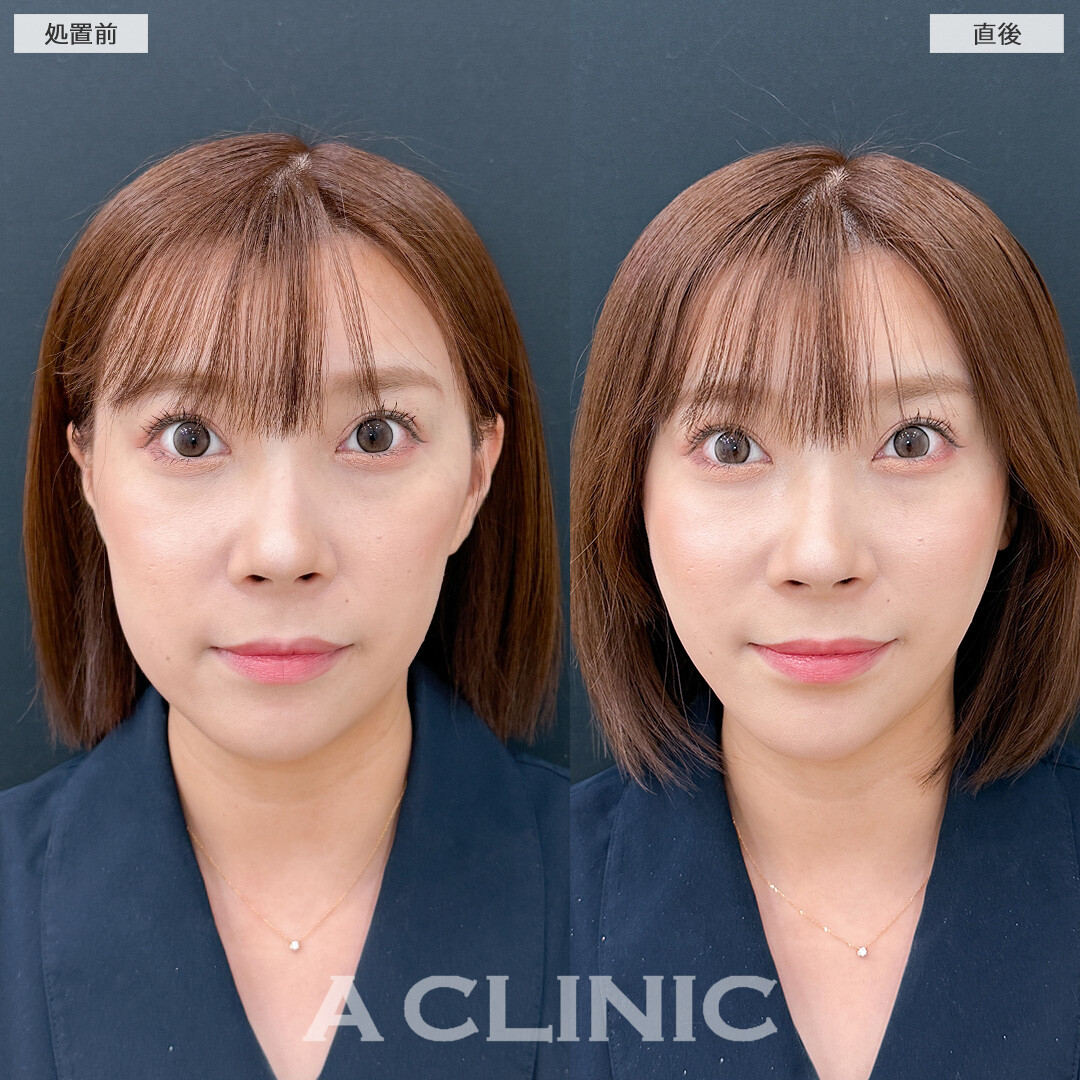 Aスレッドはお顔の左右差もなくすことができます！こちら処置前と直後の症例です(30代女性)