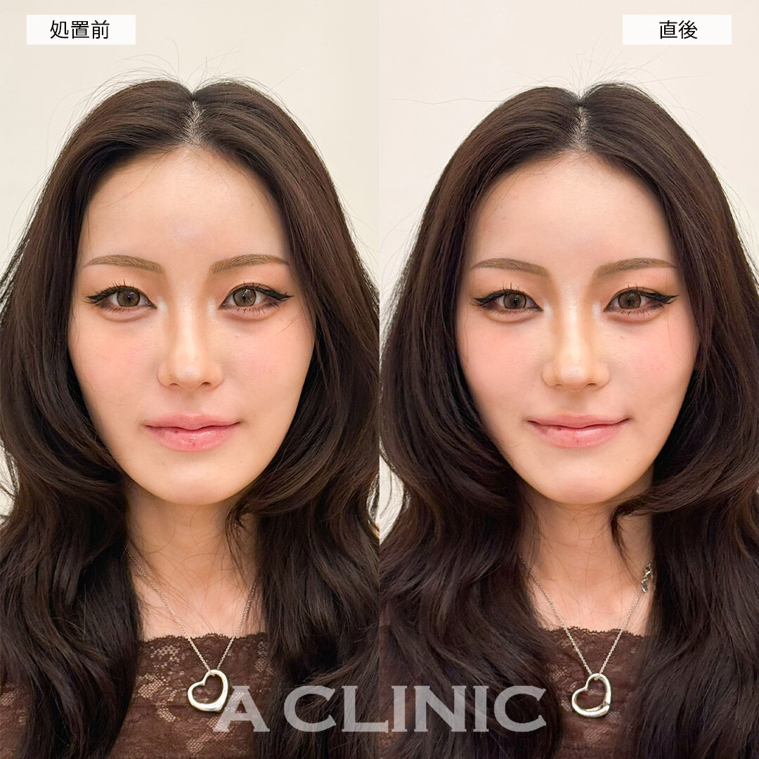 Aスレッドで痩せてたるんでしまったフェイスラインのもたつきが解消！こちら処置前と直後の症例です(20代女性)