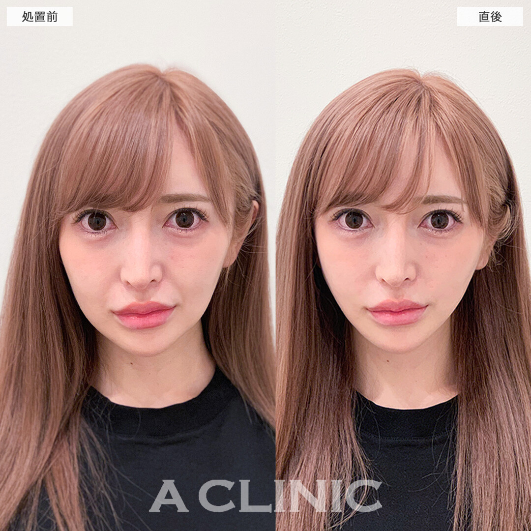 Aスレッドでほうれい線も薄くなり理想のVフェイス美人へ！こちら処置前と直後の症例です(20代女性)