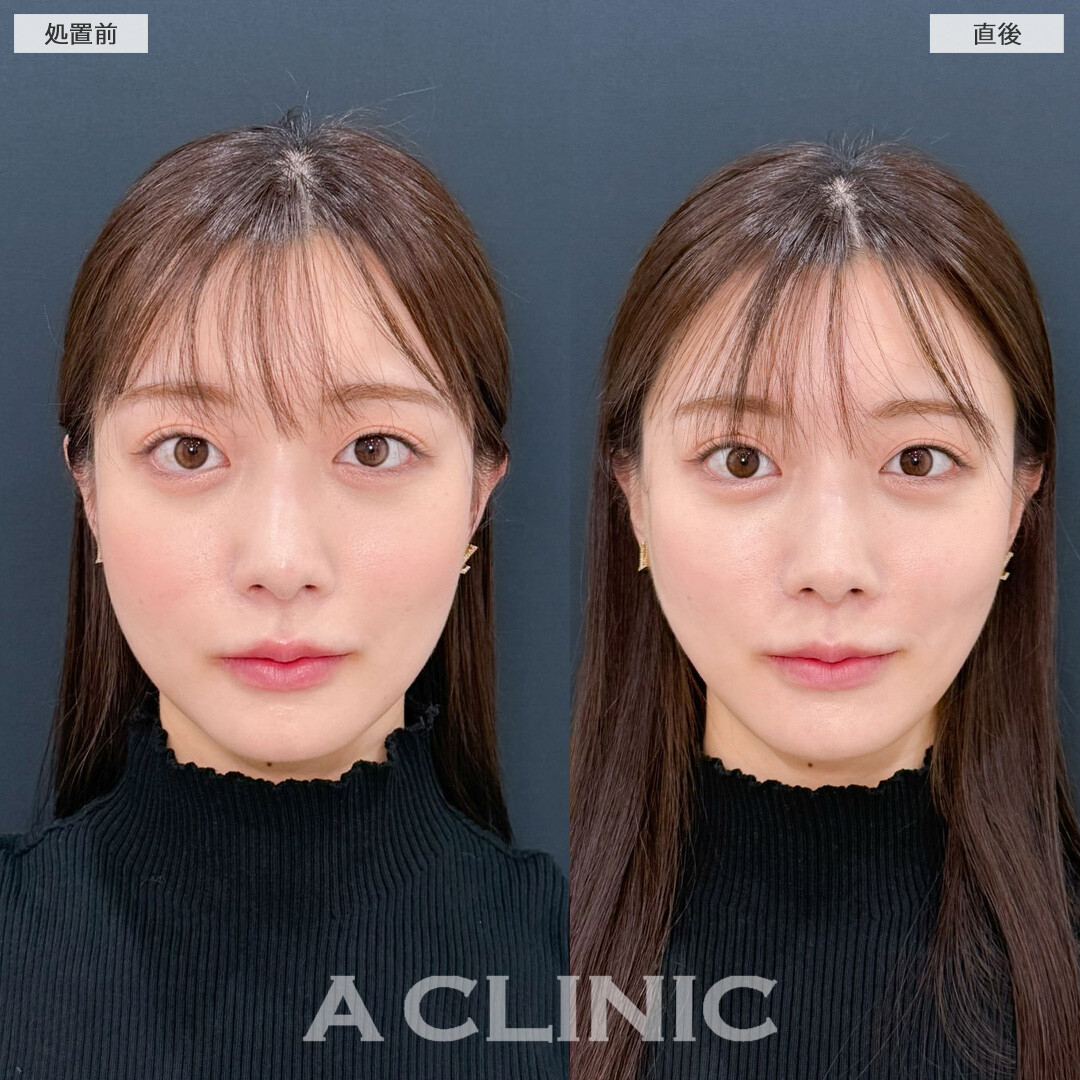 Aスレッドで左右差ともたつきを解消！こちら処置前と直後の症例です(20代女性)