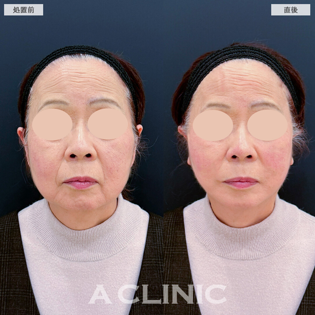 Aスレッドでたるみを即日改善！処置前と直後の症例です(60代女性)