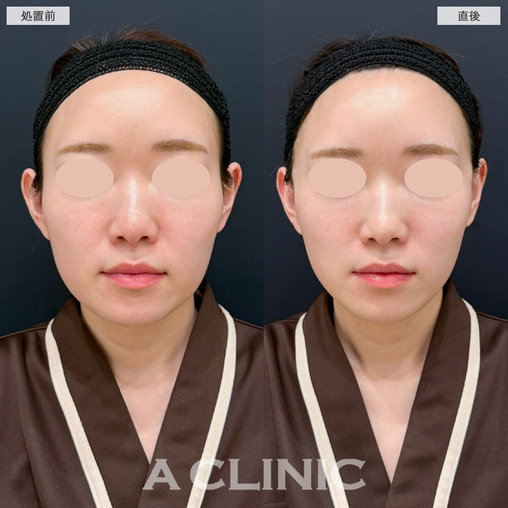 Aスレッドで口横のもたつきが改善し、フェイスラインがスッキリしました。処置前と直後の症例です(30代女性)