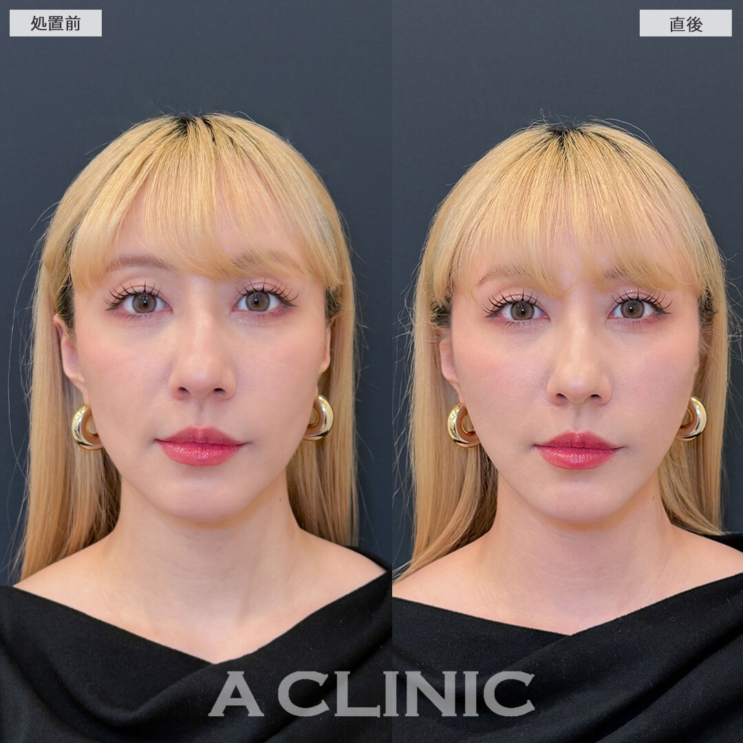 Aスレッドで直後から気になるたるみが無くなりシュッとした輪郭になりました！こちら処置前と直後の症例です(30代女性)