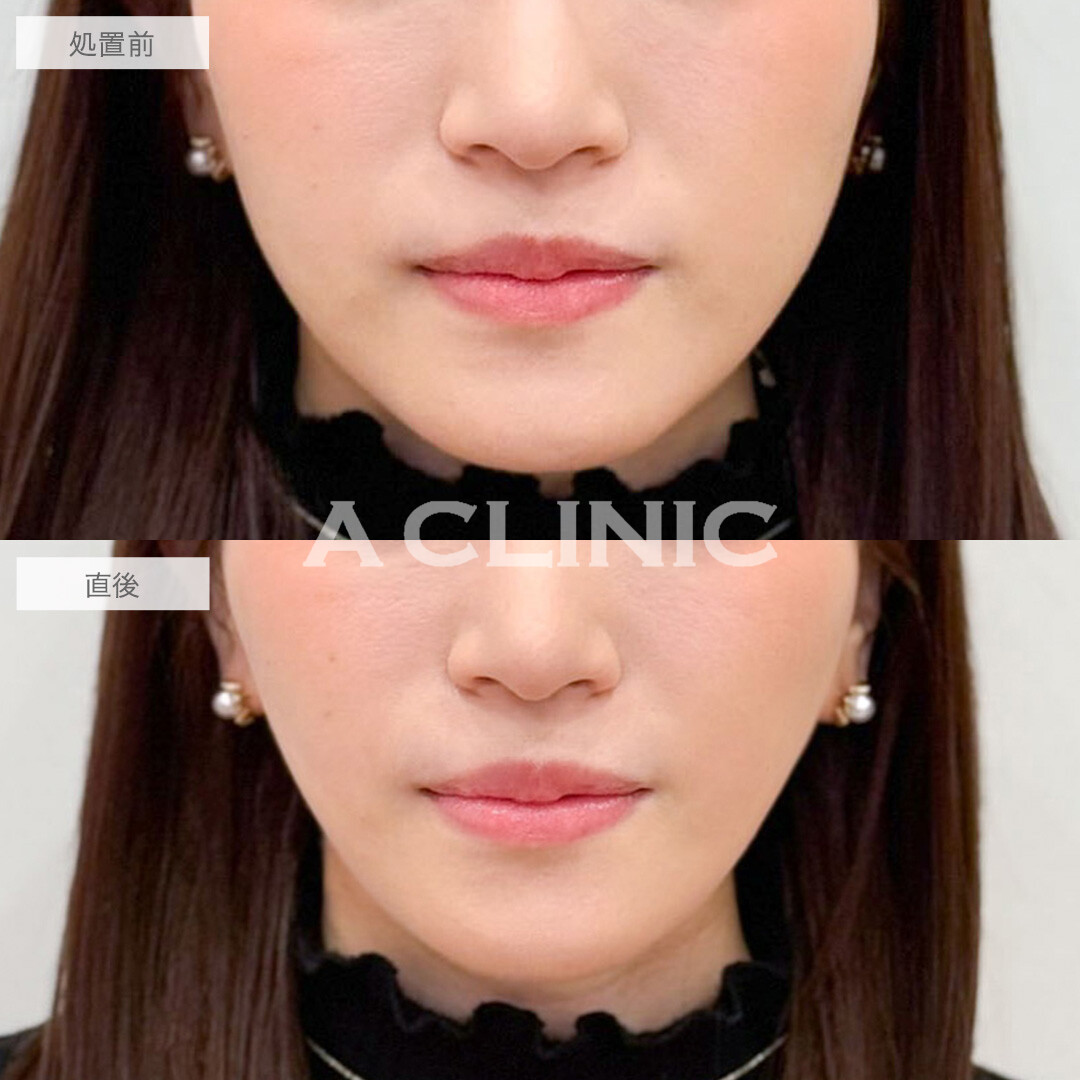 Aスレッドで頬のもたつきを解消し自然なリフトアップに成功！こちら処置前と直後の症例です(20代女性)