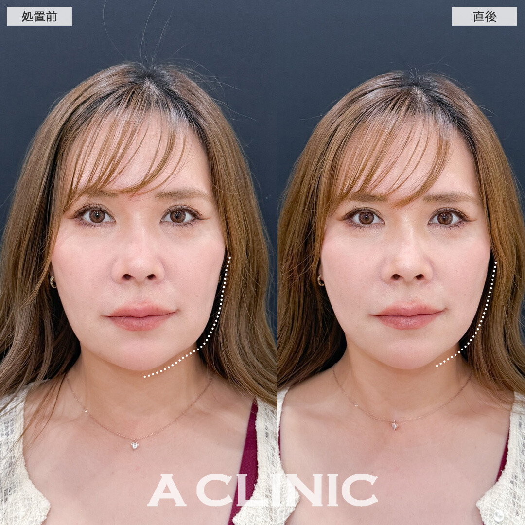 Aスレッドでなめらかなフェイスラインに！こちら処置前と直後の症例です(40代女性)
