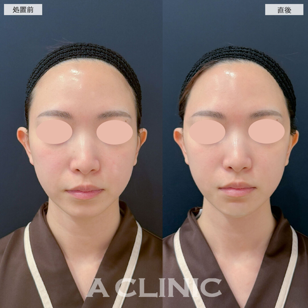 Aスレッドとあごへのヒアルロン酸注入で綺麗な卵型の輪郭になりました！こちら処置前と直後の症例です(30代女性)