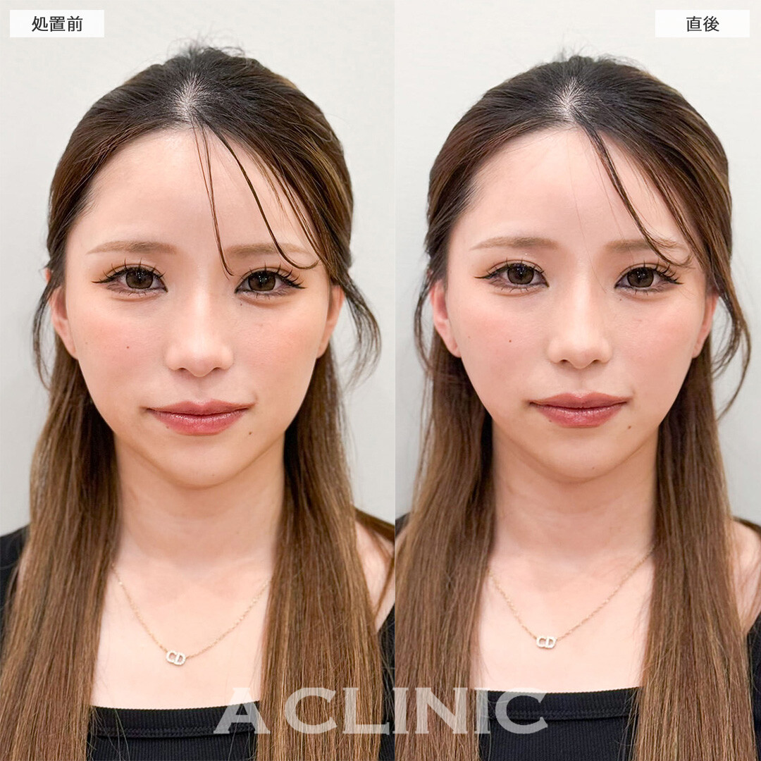 Aスレッドでもたつき改善し直後から垢抜け成功！こちら処置前と直後の症例です(20代女性)