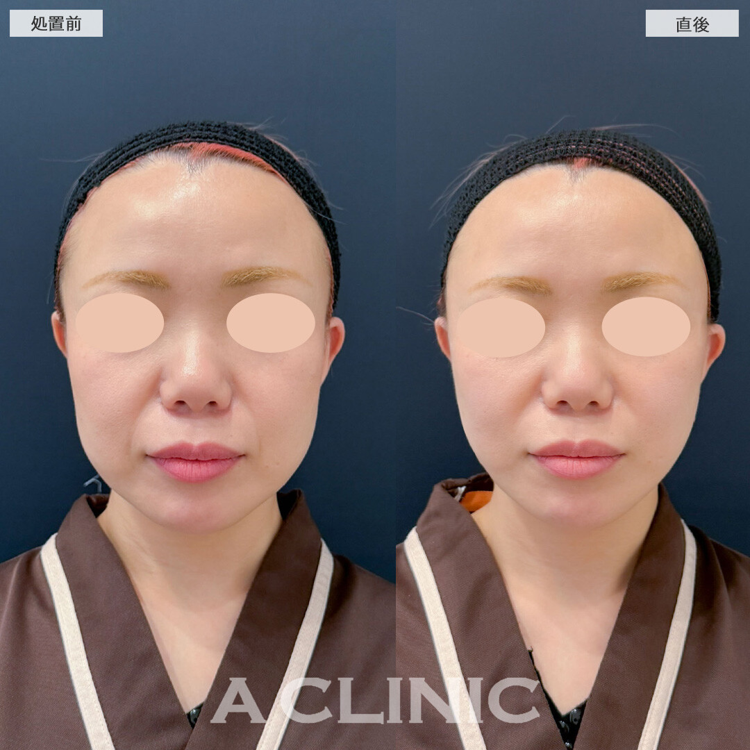 Aスレッドで口横のたるみがしっかり引きあがり若々しい印象になりました！こちら処置前と直後の症例です(40代女性)