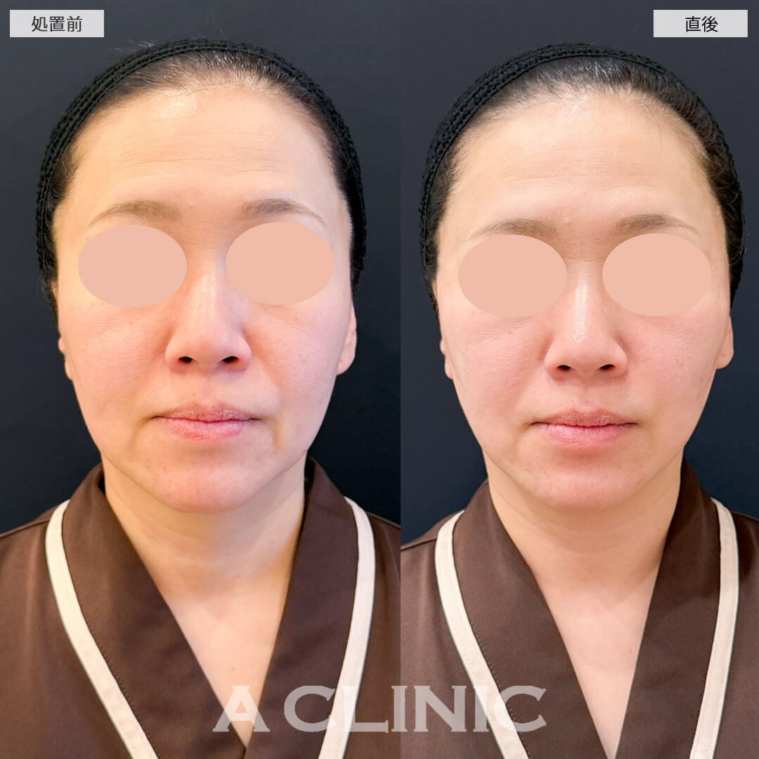 Aスレッドで重力に負けずにしっかり引き上げ！処置前と直後の症例です(50代女性)