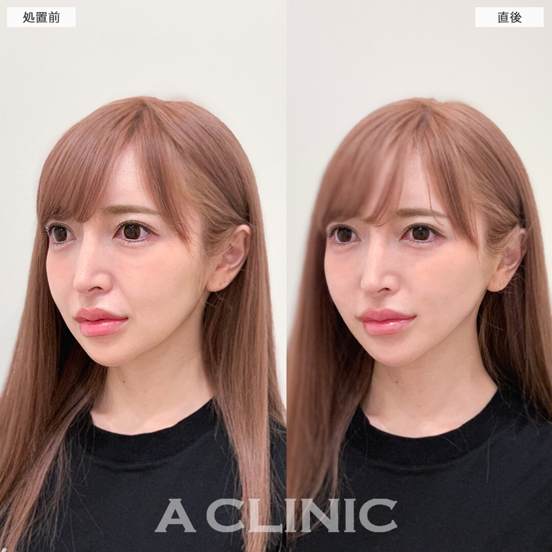 Aスレッドでほうれい線も薄くなり理想のVフェイス美人へ！こちら処置前と直後の症例です(20代女性)