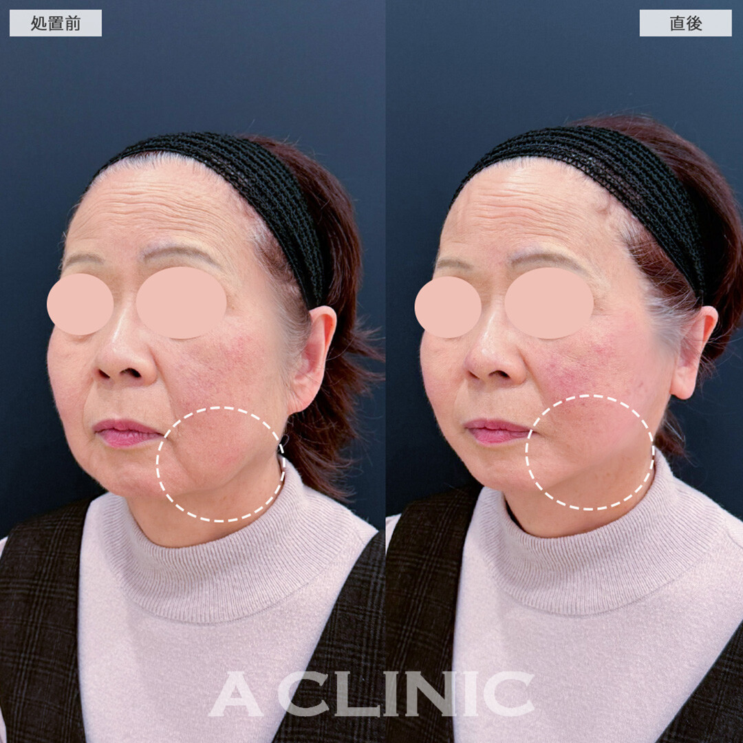 Aスレッドでたるみを即日改善！処置前と直後の症例です(60代女性)