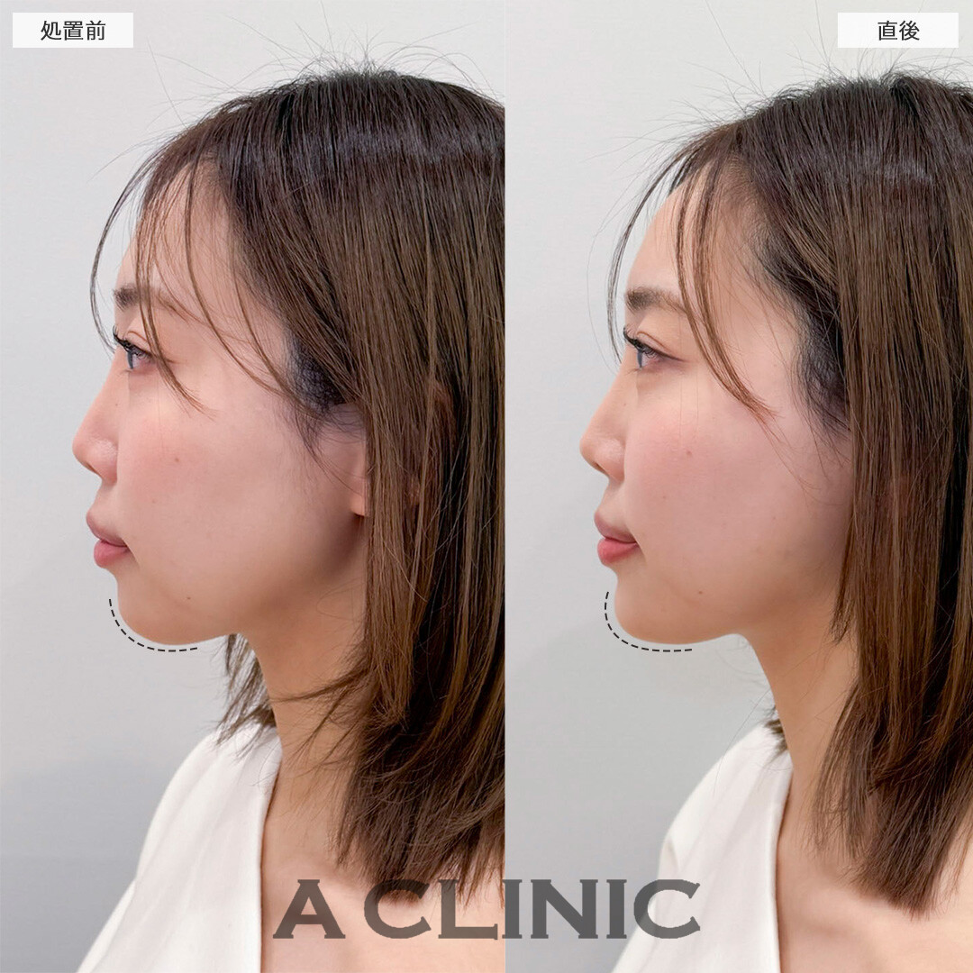 Aスレッドとあごへのヒアルロン酸注入の併用でどこから見ても美しいフェイスラインに！処置前と直後の症例です(20代女性)